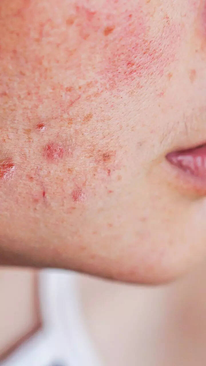 Vitamin Defciny Rashes Vitamin Deficiency Rash On Face