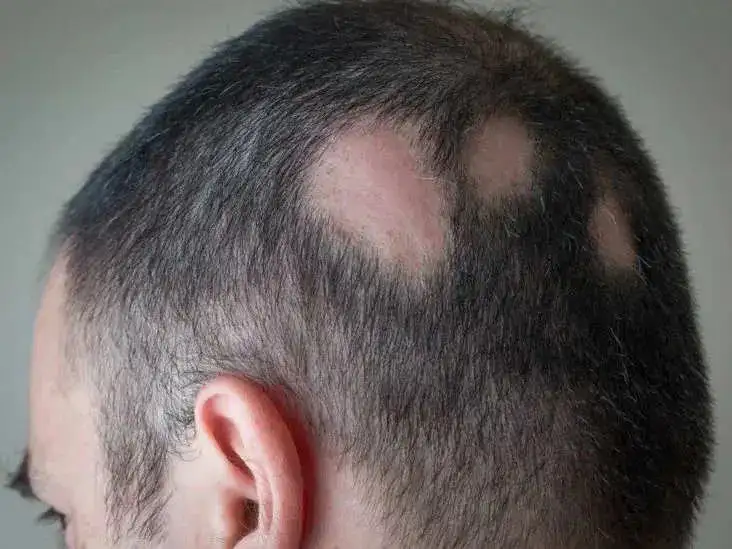 Premature Hair Loss.