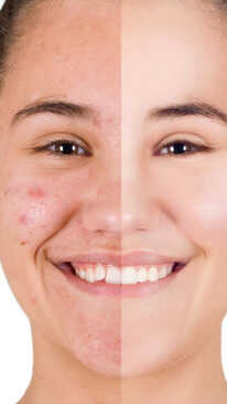 Pimple के जिद्दी दाग से हैं परेशान यूज करें ये असरदार क्रीम्स-सीरम