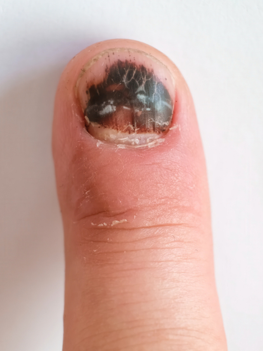  நகத்தின் கலரை வைத்து உங்களுக்கு இருக்கும் நோயை கண்டுப்பிடிக்கலாம் தெரியுமா? 