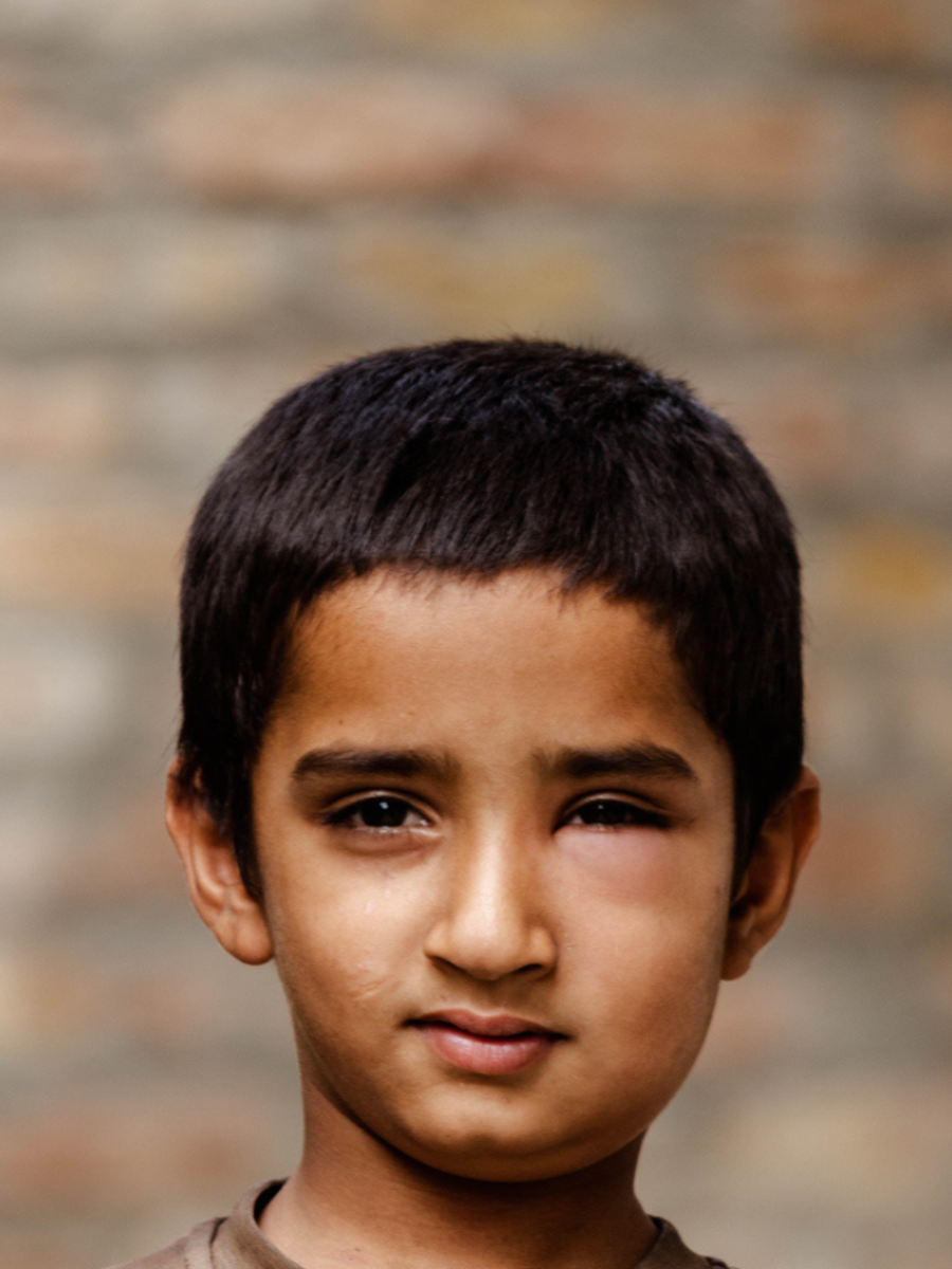  ​காலையில் தூங்கி எழுந்ததும் முகம் வீங்குகிறதா? 