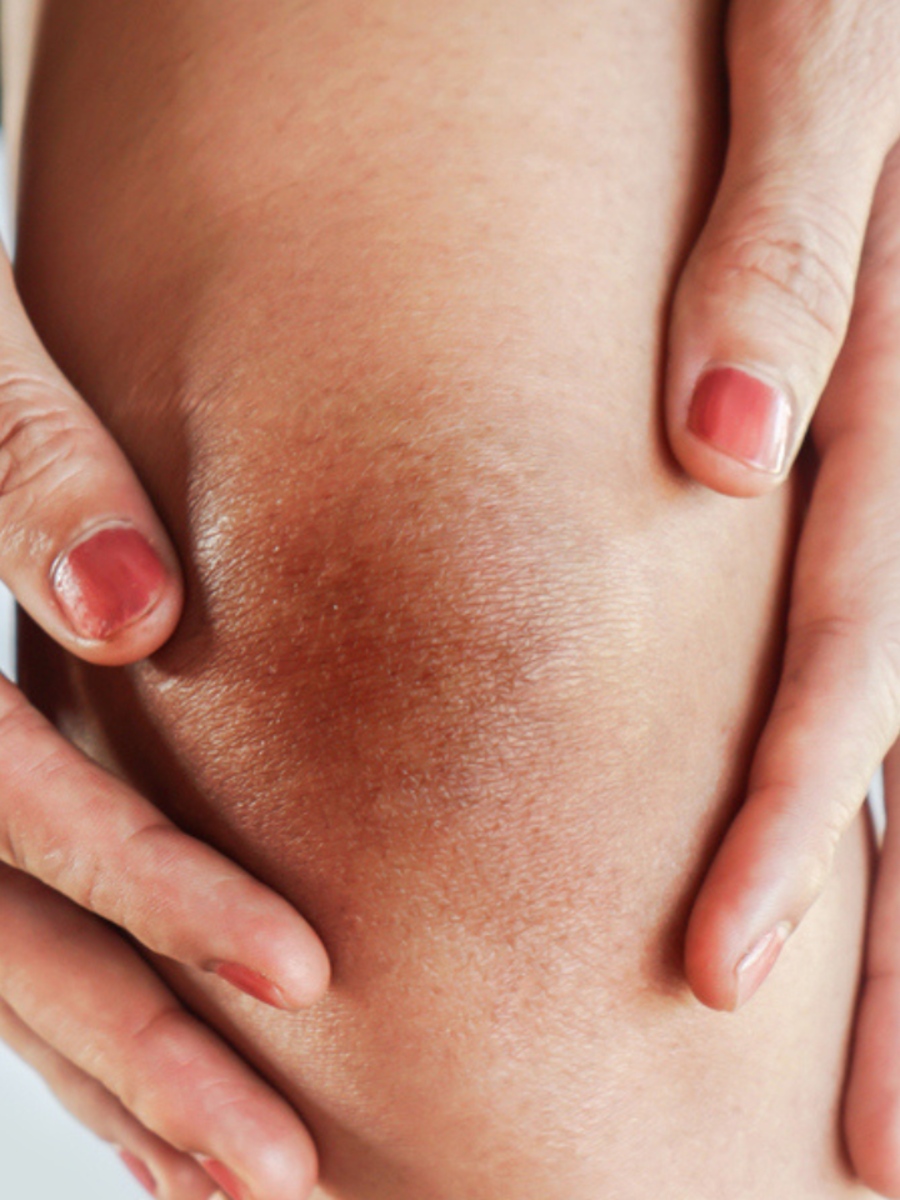  கால் முட்டி கருப்பாக என்ன காரணம்? 